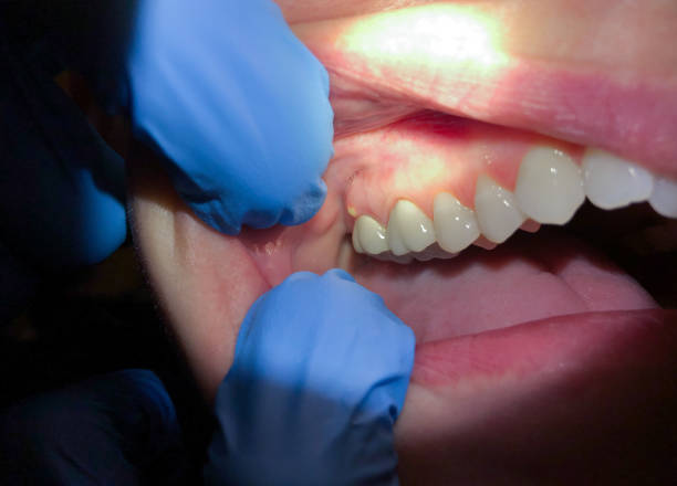 Best Knocked-Out Tooth (Avulsed Tooth) Treatment in Clermont, GA